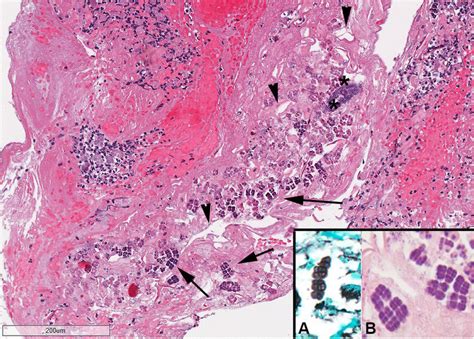 Photomicrograph Of The Gastric Biopsy Necrotic Gastric Mucosa Hande Download Scientific Diagram