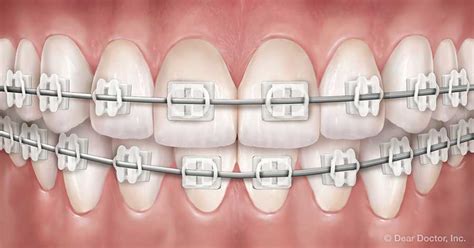 Adult Treatment Evans Orthodontics Rapid City South Dakota