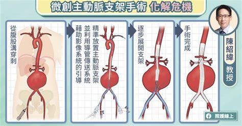 照護線上》致命的主動脈剝離與主動脈瘤，微創主動脈支架手術治療解析，心臟血管外科醫師圖文說明 自由評論網