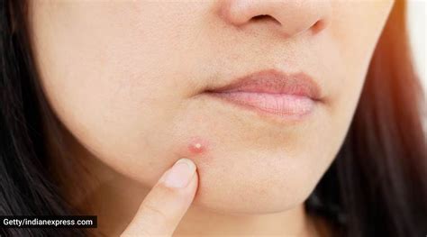 Nodular Acne Symptoms Causes And How To Treat It Ph