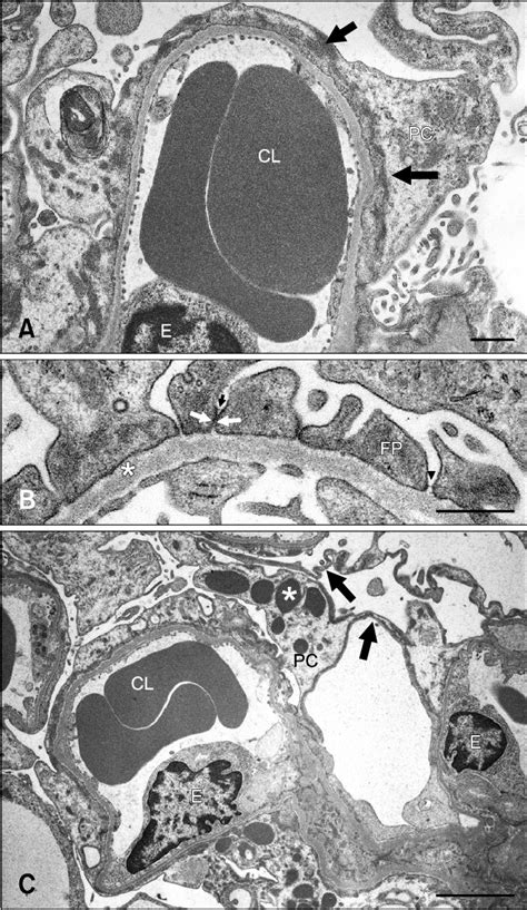 A Severe Podocyte Foot Process FP Effacement With Rearrangement Of