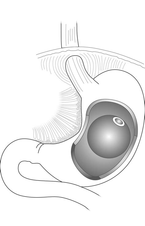 Gastric Balloon Surgery - GastricBand.Clinic