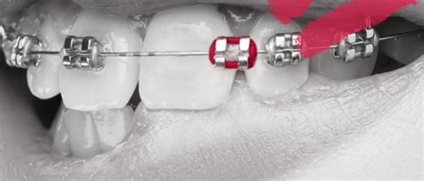 Top Five Tips To Save You From A Broken Bracket