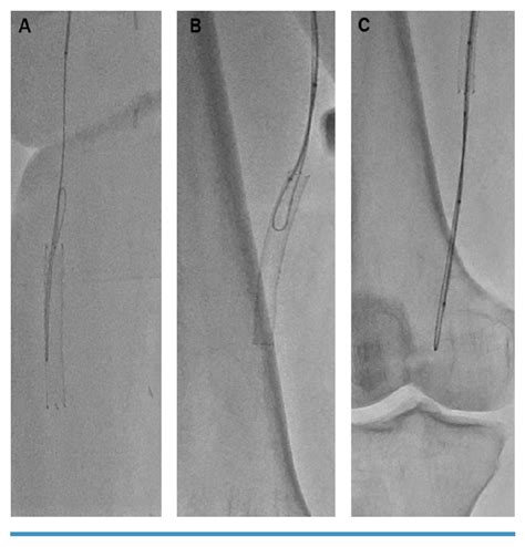 Limb Salvage Endovascular Technique In Chronic Limb Threatening Ischemia Journal Of Cli