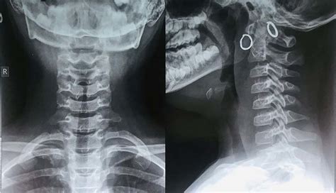 Post Operative X Ray Soft Tissue Neck Anteroposterior And Lateral View Download Scientific