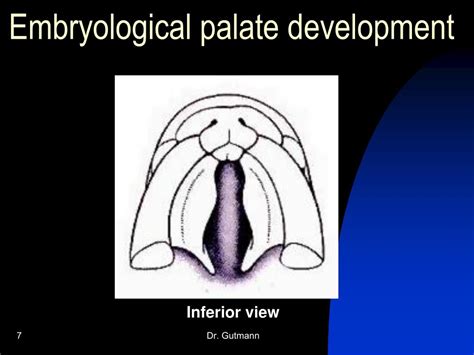 Ppt Cleft Lip And Palate Powerpoint Presentation Free Download Id