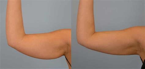 How To Get Rid Of Flabby Arms 4 Effective Exercises