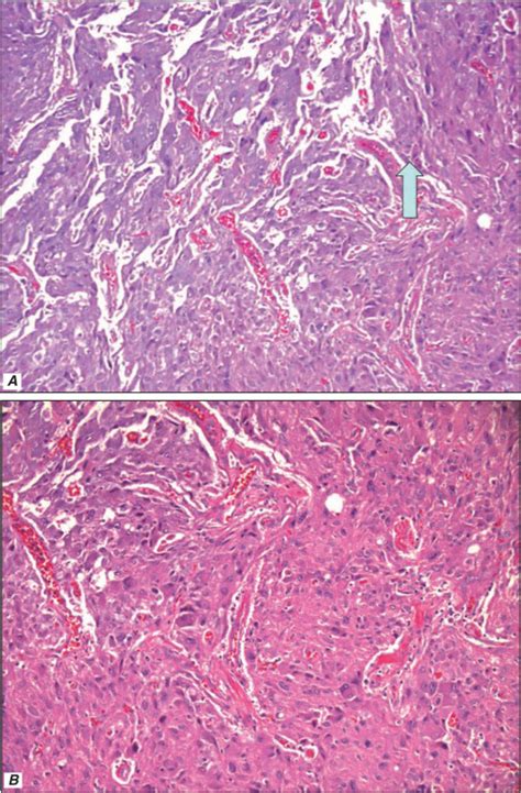 Association Of Pheochromocytoma And Ganglioneuroma Unusual Finding In Neurofibromatosis Type 1