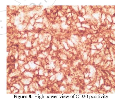 Figure 1 From A Rare Case Of Primary Cutaneous Diffuse Large B Cell