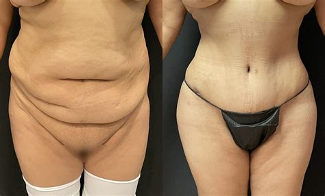 Abdominoplasty Before And After Photos Joshua Jacobson Md