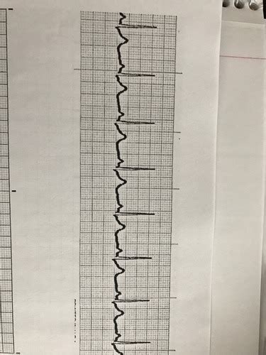 EKGS Flashcards Quizlet