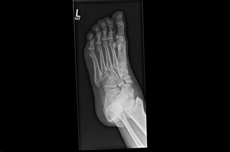 Orthodx Left Foot Injury After Fall From Ladder Clinical Advisor