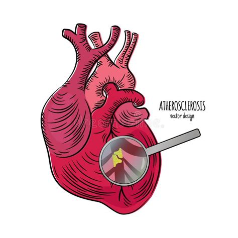 Heart Disease Atherosclerosis Medicine Education Vector Scheme Stock