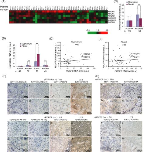 Increased Expression Of Pdgfc In Uterine Fibroids A Pdgf And Pdgfr