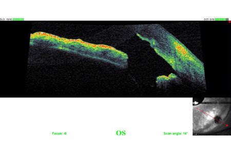 Centro Italiano Glaucoma Iridotomia Yag Laser