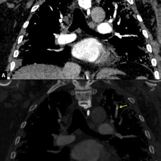 Endovascular Embolisation Of The Left Apical Pulmonary Artery