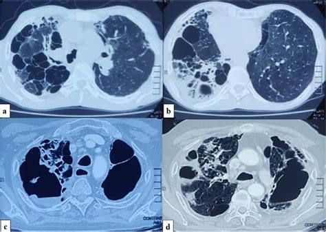 E Hrct Chest Showing Different Pattern Of Aspergillosis Radiology