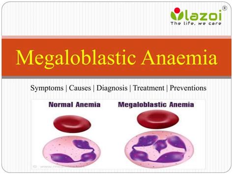 Megaloblastic Anaemia Symptoms Causes Diagnosis Treatment And Preventions Ppt