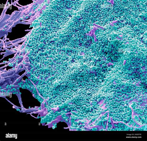 Hiv Infizierte T Zelle Farbige Scanning Electron Micrograph Sem