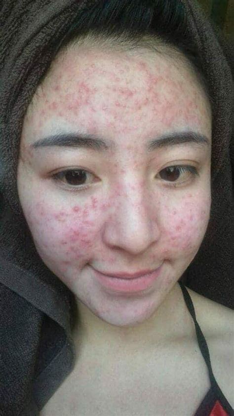 Xuất hiện ảnh hot girl bánh tráng trộn đình đám một thời nổi mụn chi