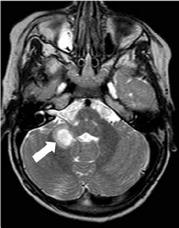 Axial T Weighted Mr Image At The Level Of Cerebellum Shows A