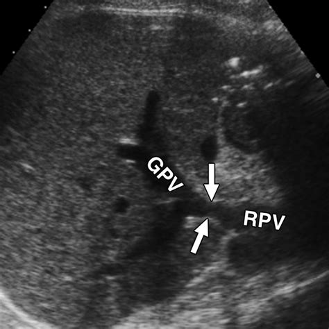 Influence Of Preoperative Portal Hypertension And Graft Size On Portal