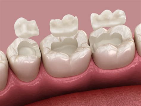 Coral Gables Fl Dental Inlays Onlays Gables Ismile