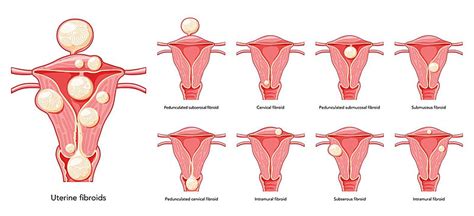 Uterine Fibroids In Female Reproductive System Anatomy Problem Uterine