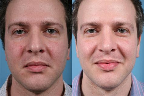 Rhinoplasty Before After Photos Patient Chicago Il Tlkm