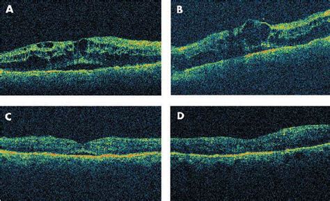 Oct Examination Of The Right Eye A And Of The Left Eye B