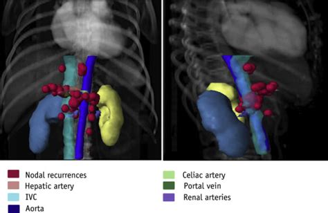 Prognostic Factors And Patterns Of Locoregional Failure After Surgical