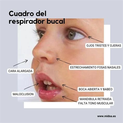 CUADRO DEL RESPIRADOR BUCAL MIDSA Odontologia