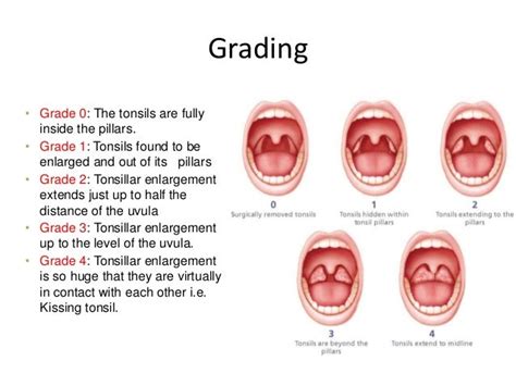 how do my tonsils look? : r/tonsilstones