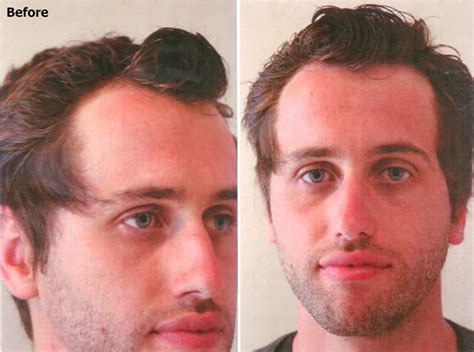 Hairline And Temple Restoration Alvi Armani Hair Transplant Los Angeles