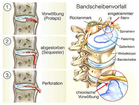 Bandscheibenvorfall Olaf Sanne Heilpraktiker in Köln