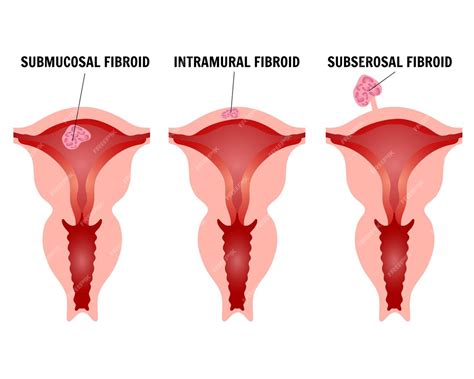 Premium Vector Infographic Or Female Fibroids In Vector Illustration