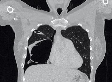 Large Air Filled Intrapulmonary Bronchogenic Cyst Associated With