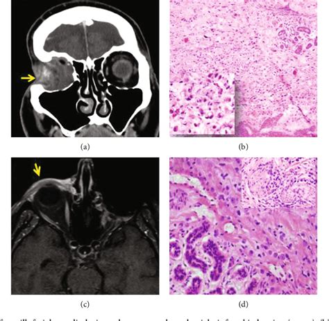 Figure From Primary Signet Ring Cell Histiocytoid Carcinoma Of The