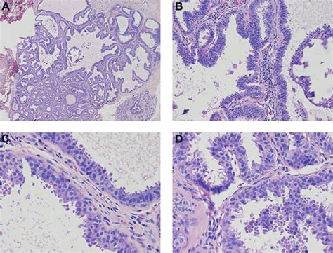 Flat epithelial atypia (4 A-D) Flat epithelial atypia usually shows... | Download Scientific Diagram