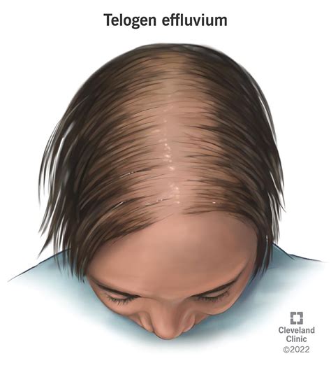 Telogen Effluvium Symptoms Causes Treatment Regrowth 42 Off