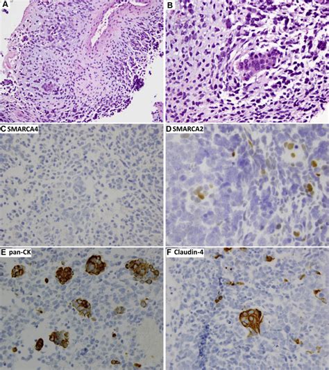 Smarca4 Deficient Thoracic Sarcomatoid Tumors Represent Primarily Smoking Related