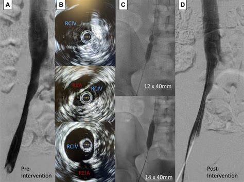 Images From Right Common Iliac Venogram With Intravascular Ultrasound Download Scientific