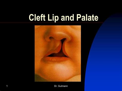 Ppt Cleft Lip And Palate Powerpoint Presentation Free Download Id1413458