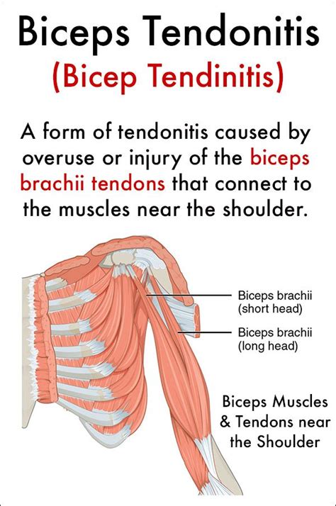 Causes Bicep Tendonitis