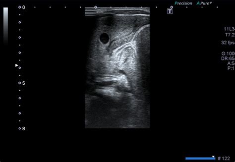 Hypertrophic Pyloric Stenosis Image