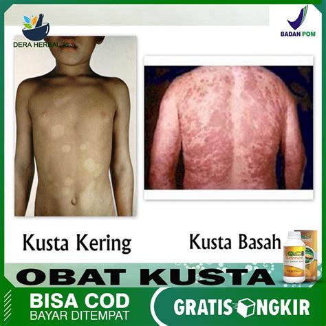 Jual Obat Kusta Lepra Kusta Kering Kusta Basah Obat Penyakit