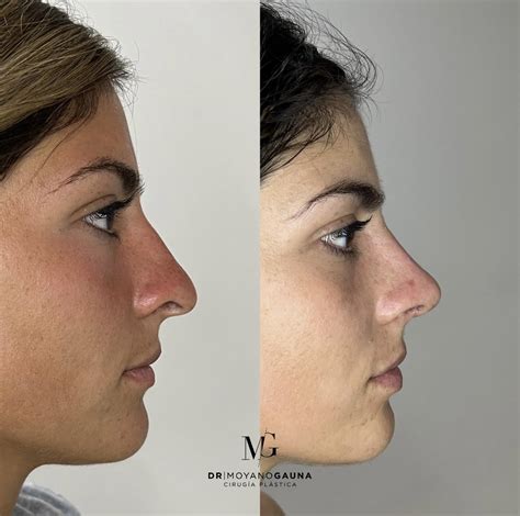 Rinoplastia antes y después Doctor Moyano Gauna