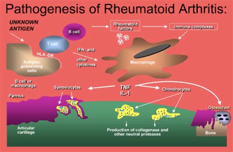 Rheumatology Rheumatoid Arthritis Flashcards Quizlet