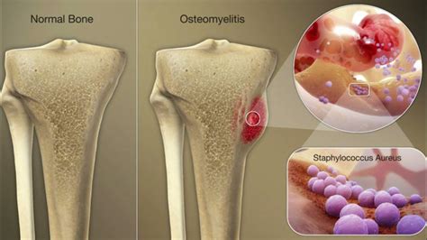 Osteomielitis Youtube