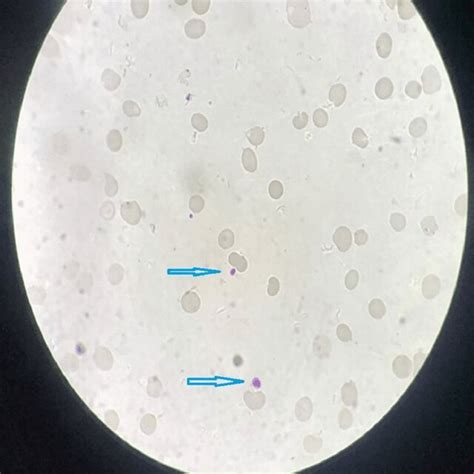 Peripheral Blood Smear X Oil Immersion Leishman Stain Showed Few